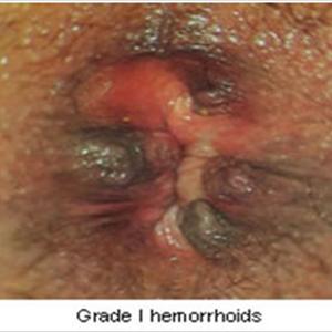 Hemorrhoids Herbs - A List Of The Top Treatments For Hemorrhoids