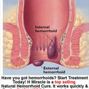 Cure Of Hemorrhoids - Help In Curing Hemorrhoids!