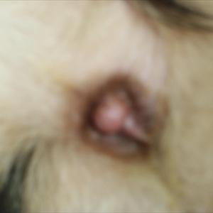 Hemorrhoid Operations - Hemorrhoids Treatments - Home And Surgery
