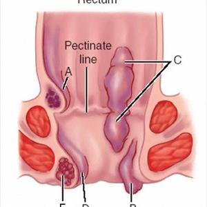 Hemorrhoid Remedy - Hemorrhoids Treatments - Hemorrhoids Diagnosis - Hemorrhoids Symptoms