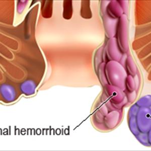 Homeopathic Remedy For Hemorrhoids - How Long Do Hemorrhoids Stay