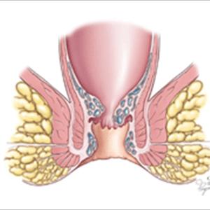Thrombosed Hemorrhoid Pictures - Know Just When To Buy And Use A Hemorrhoid Treatment