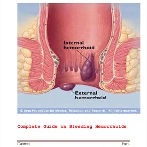 Homeopathic Remedies For Hemorrhoids - Best OTC Hemorrhoid Treatment