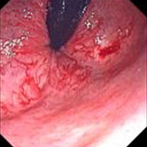 Cause Of Hemorrhoids - Hemorrhoids, Itching And Pain In Private Area Remedies To Cure It