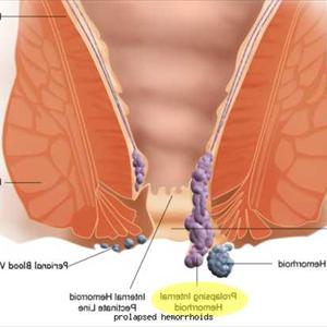 Hemorrhoids Cancer - Why Simple Hemorrhoid Treatment Is More Effective And Preferable