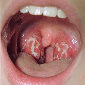 Thrombosed Hemorrhoids Picture - Know Just When To Buy And Use A Hemorrhoid Treatment