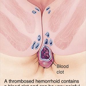 Hemroids Natural Cures - Natural Hemorrhoid Treatment With Herbs
